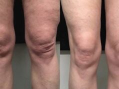 Knieartrose ‘s avonds verlichten in 5 minuten: probeer deze eenvoudige bedtijdroutine